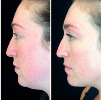 Kybella Before and After