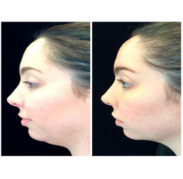Kybella Treatment Result