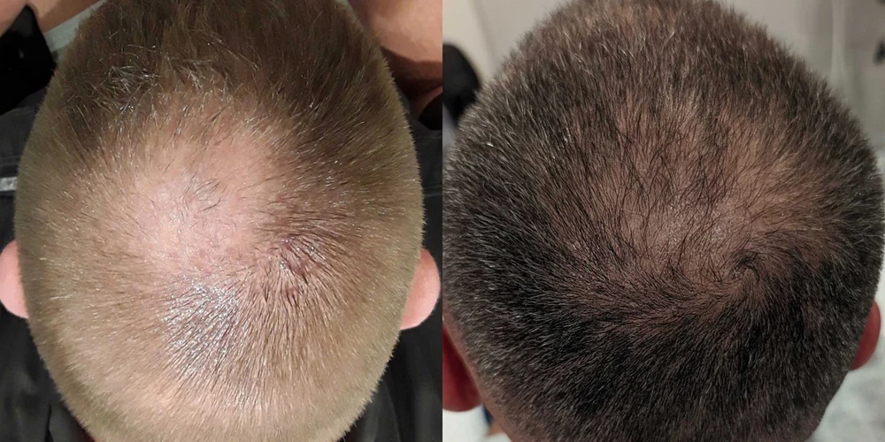 Hair regrowth after 3 sessions