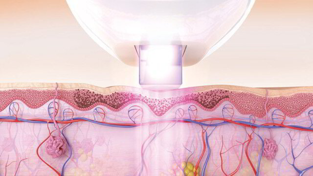 IPL Venus Versa result 1