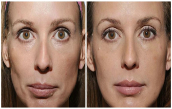 Sculptra Before and After