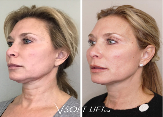 Thread Lift Visual