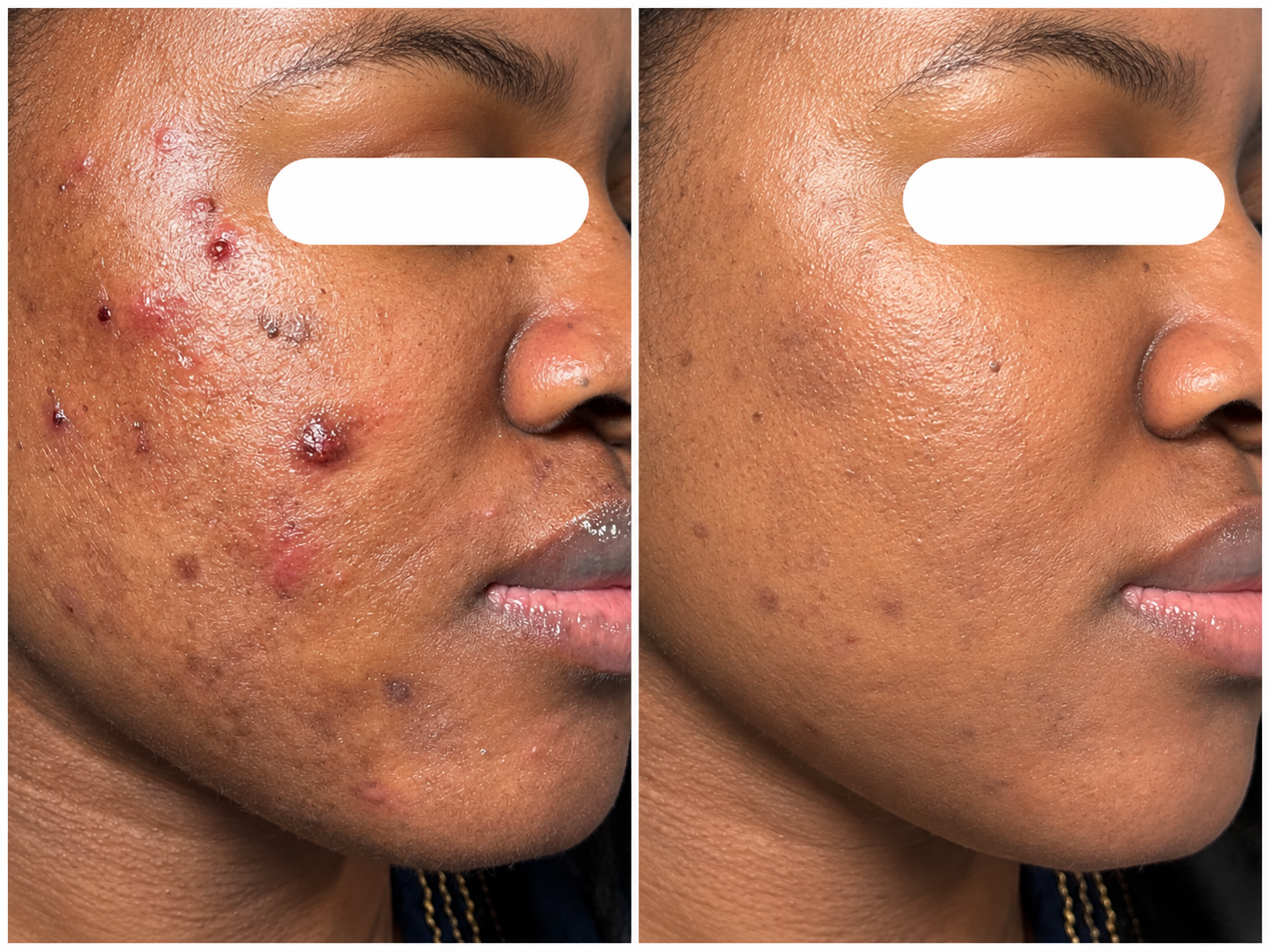 Illustrative side-by-side comparison of acne-prone facial skin